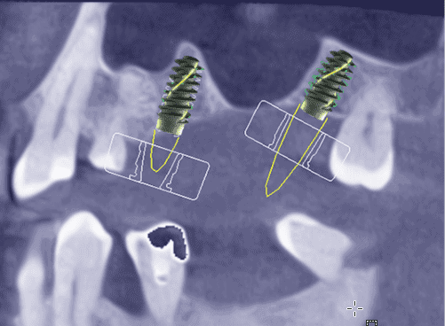 Navigierte Implantologie mit 3D Röntgen